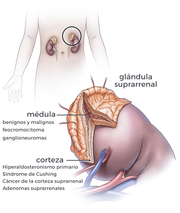 tumores adrenales